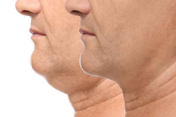 HIFU - Breakthrough in Anti - ageing 2 hifu results Feltham