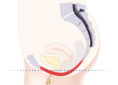 Pelvic-Floor Muscle Repair 5 Pelvic floor muscles Feltham