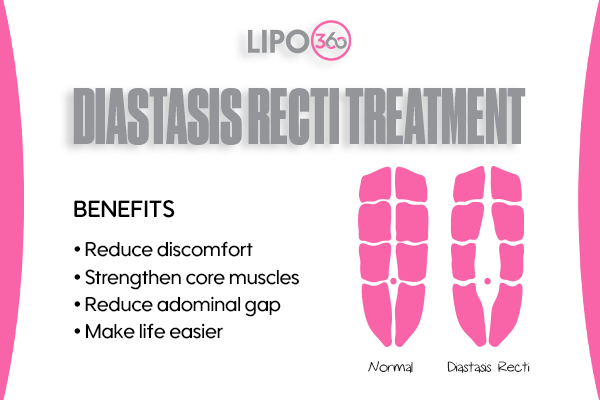 Revolutionising Muscle Repair: The Power of LIPO360 Body Sculpt Post-Injury 5 diastasis recti treatment Feltham