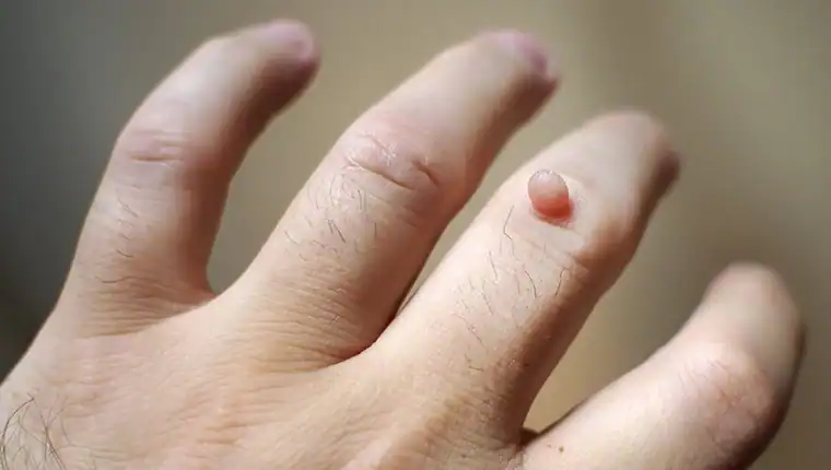 Image of blemish that Cryotherapy Feltham can remove with Lipo 360.