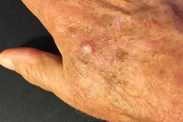 Image of Actinic keratoses Feltham on a person hand